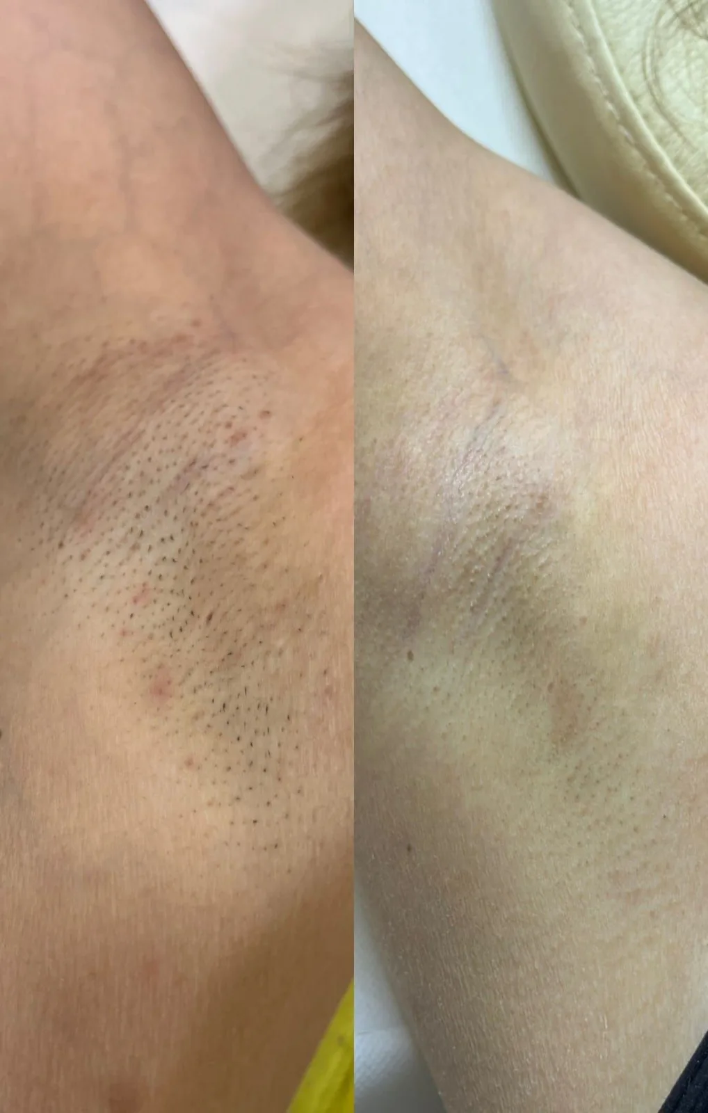Axile înainte și după epilarea definitivă cu laser diodă