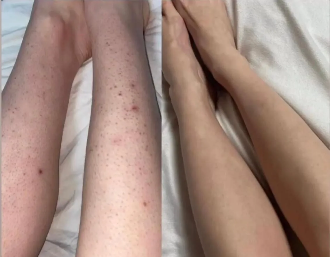 Picioare înainte și după epilarea definitivă cu laser diodă